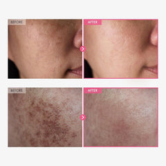 Prandest Arbutin 7% + Tranexamic Acid 4% Cream